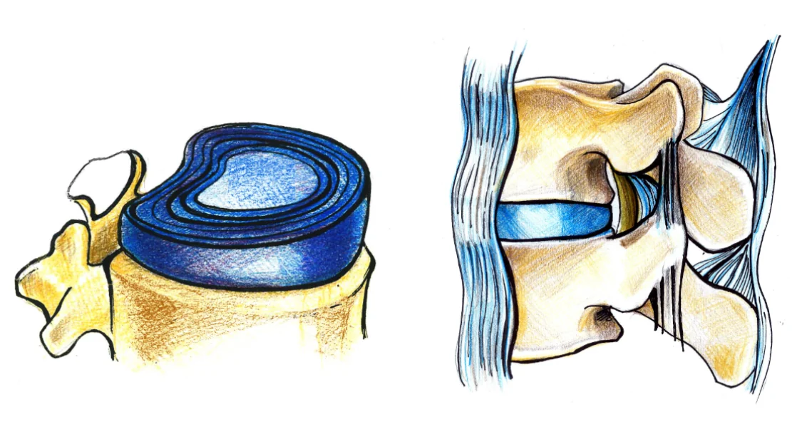 Discul intervertebral